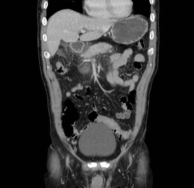 File:Acute pancreatitis (Radiopaedia 22572-22596 Coronal C+ portal venous phase 17).jpg