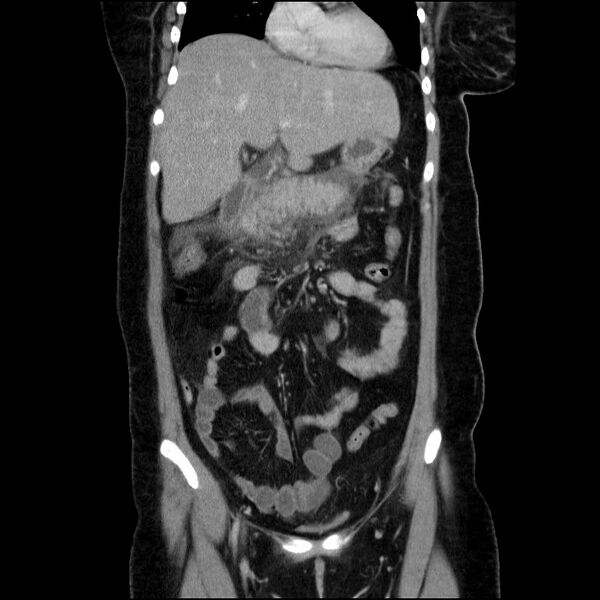 File:Acute pancreatitis (Radiopaedia 69236-79012 Coronal C+ portal venous phase 48).jpg
