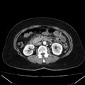 Acute pancreatitis - Balthazar C (Radiopaedia 26569-26714 Axial C+ arterial phase 41).jpg