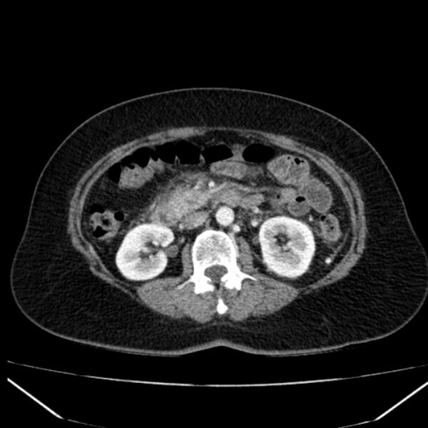 File:Acute pancreatitis - Balthazar C (Radiopaedia 26569-26714 Axial C+ arterial phase 41).jpg