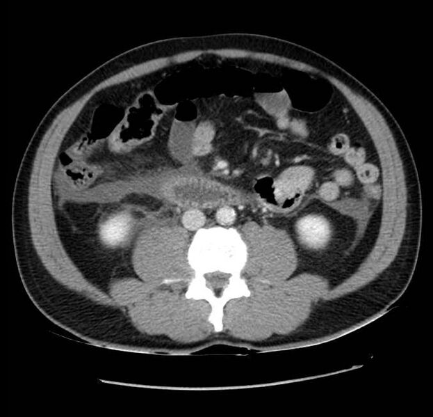 File:Acute pancreatitis - Balthazar E (Radiopaedia 23080-23110 Axial C+ portal venous phase 38).jpg