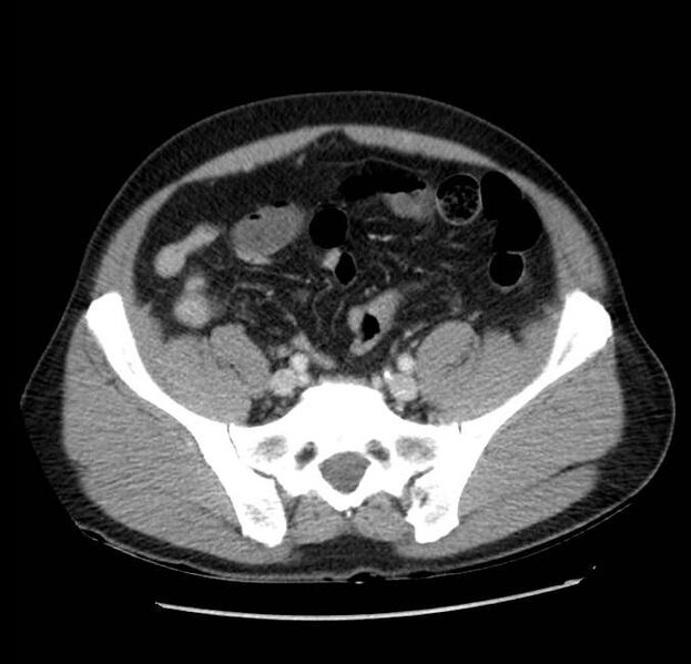 File:Acute pancreatitis - Balthazar E (Radiopaedia 23080-23110 Axial C+ portal venous phase 54).jpg