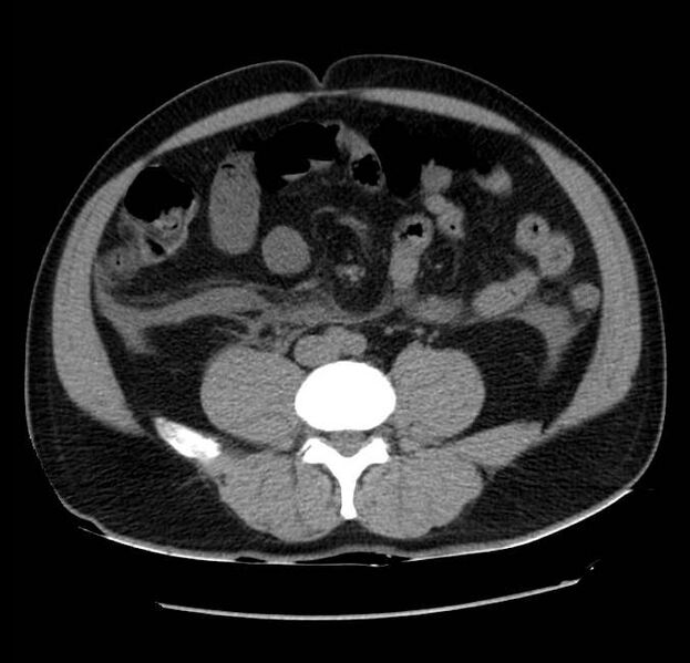 File:Acute pancreatitis - Balthazar E (Radiopaedia 23080-23110 Axial non-contrast 43).jpg