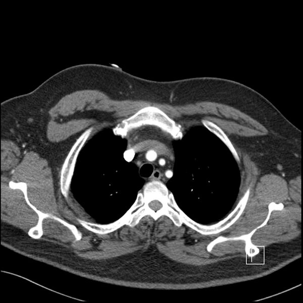 File:Acute pulmonary embolism with pulmonary infarct (Radiopaedia 73062-83768 Axial C+ CTPA 12).jpg