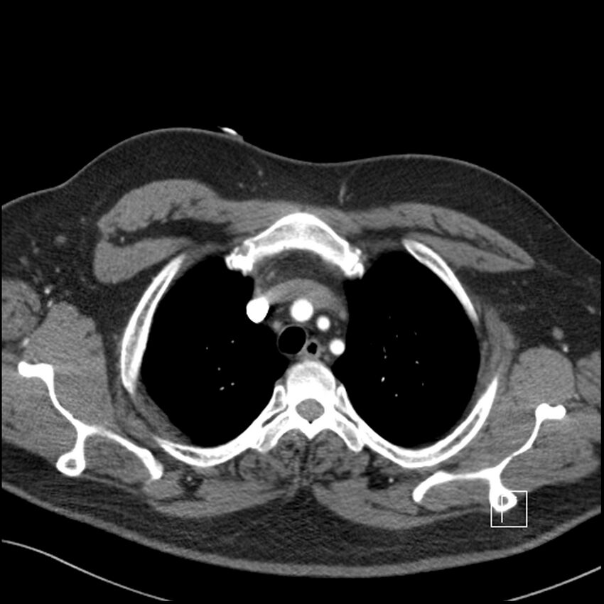 Acute pulmonary embolism with pulmonary infarct (Radiopaedia 73062-83768 Axial C+ CTPA 12).jpg