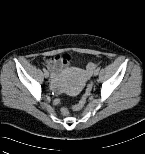 File:Acute pyelonephritis (Radiopaedia 40264-42816 Axial renal excretory phase 30).jpg