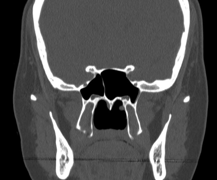 File:Acute sinusitis (Radiopaedia 22419-22455 Coronal bone window 29).jpg