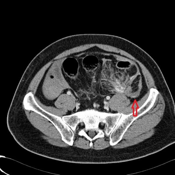 File:Acute traumatic mesenteric bleed (Radiopaedia 37561-39660 Axial portal venous 1).jpg