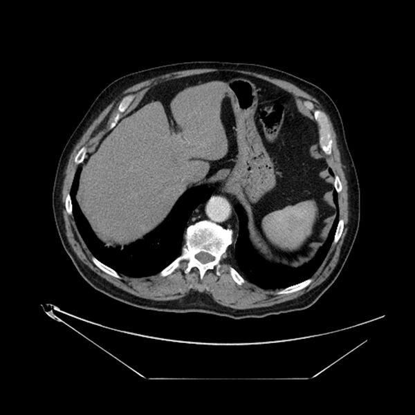 File:Adenocarcinoma of the lung (Radiopaedia 44876-48759 Axial C+ portal venous phase 74).jpg