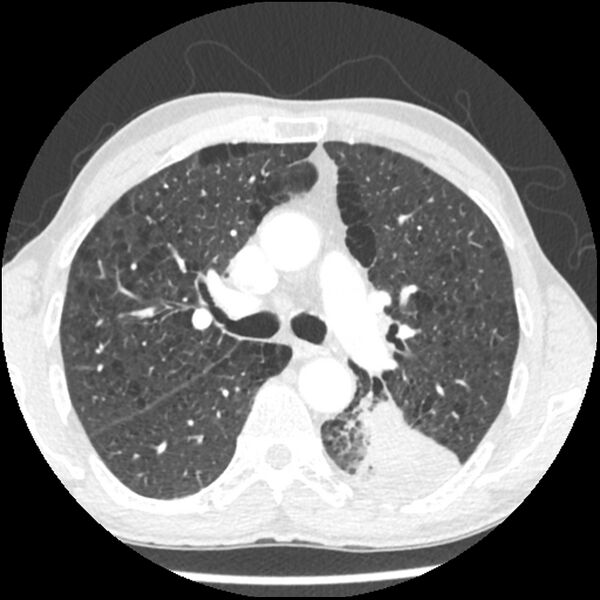 File:Adenocarcinoma of the lung - micropapillary predominant (Radiopaedia 42446-45563 C 24).jpg