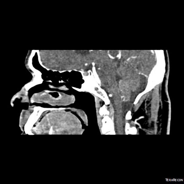 File:Adenoid cystic carcinoma involving paranasal sinus (Radiopaedia 16580-16283 Sagittal C+ arterial phase 1).jpeg
