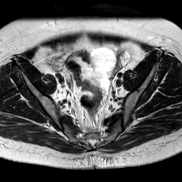 File:Adenomyoma of the uterus (Radiopaedia 9871-10439 Axial T2 21).jpg