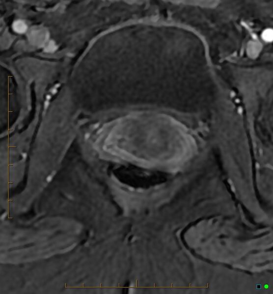 File:Adenomyosis uterus with hematometra (Radiopaedia 45779-50011 Axial T1 C+ fat sat 59).jpg
