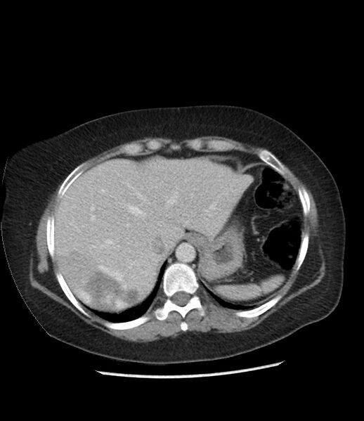File:Adrenal cortical carcinoma with IVC invasion and thrombosis (Radiopaedia 34307-35597 Axial C+ portal venous phase 14).jpg
