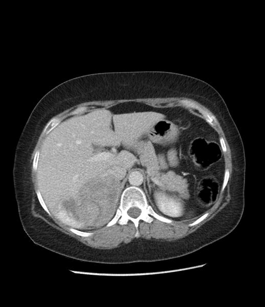 File:Adrenal cortical carcinoma with IVC invasion and thrombosis (Radiopaedia 34307-35597 Axial C+ portal venous phase 23).jpg