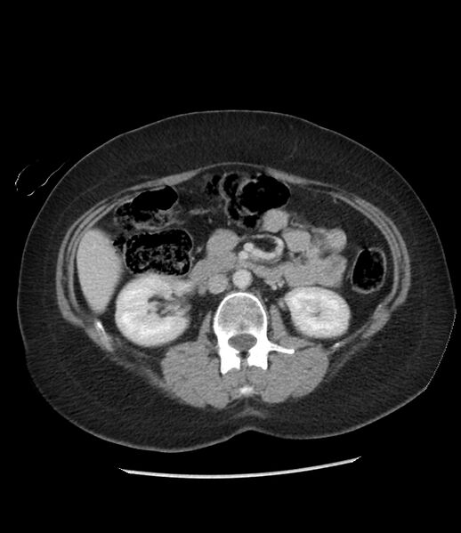 File:Adrenal cortical carcinoma with IVC invasion and thrombosis (Radiopaedia 34307-35597 Axial C+ portal venous phase 40).jpg