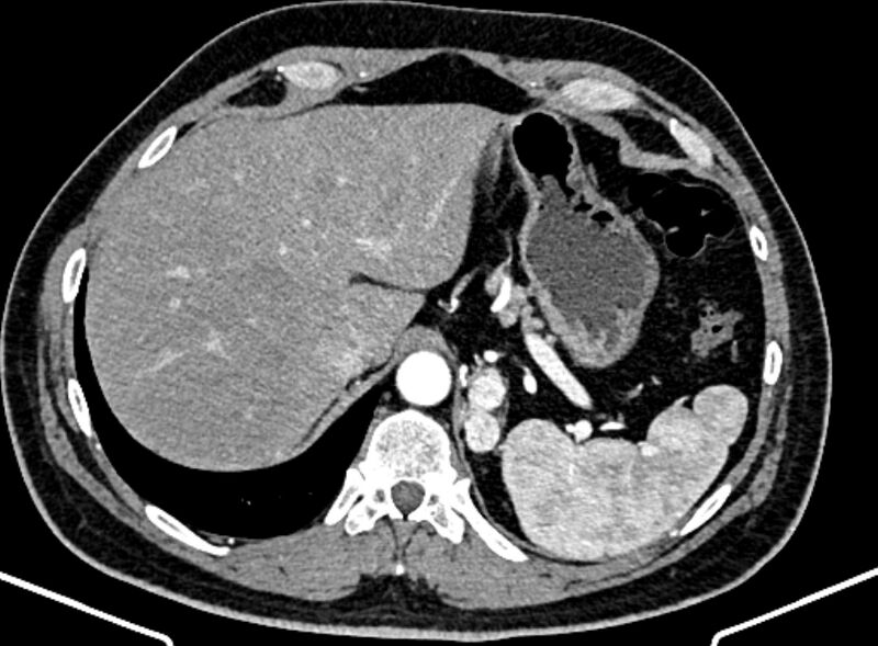 File:Adrenal metastases (Radiopaedia 73082-83791 Axial C+ arterial phase 31).jpg