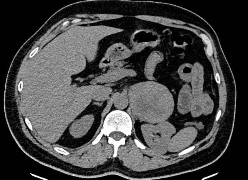 File:Adrenal metastases (Radiopaedia 73082-83791 Axial non-contrast 53).jpg