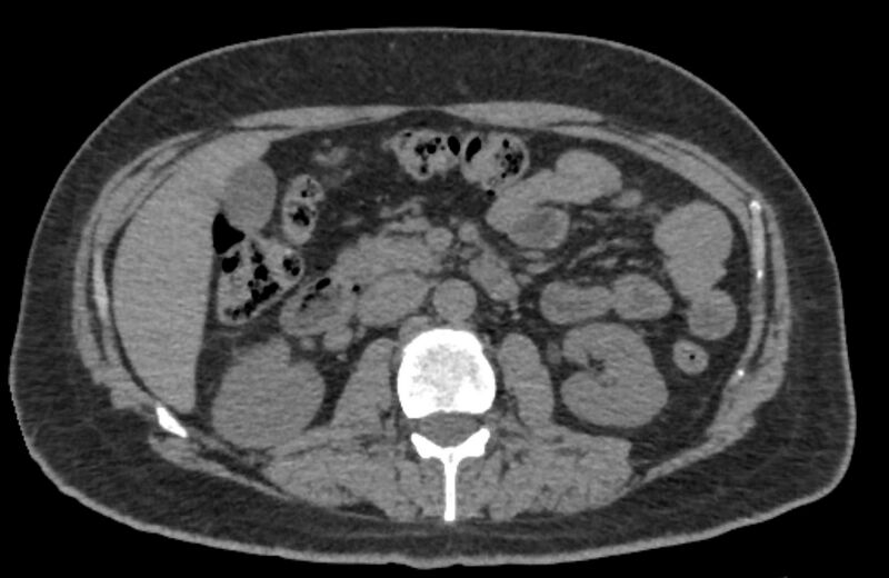 File:Adrenal myelolipoma (Radiopaedia 65240-74253 Axial non-contrast 62).jpg