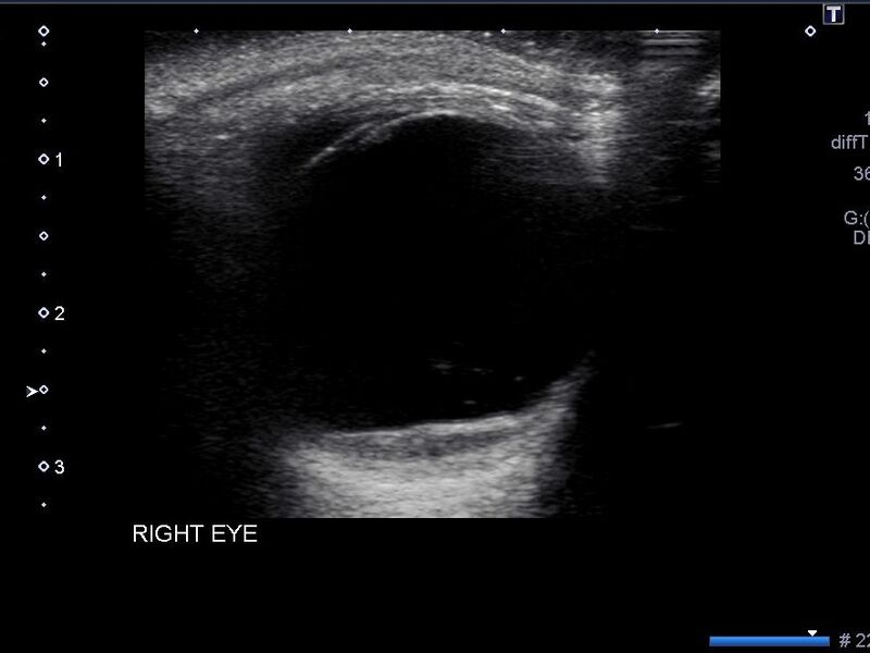 File:Amelanotic retinal melanoma (Radiopaedia 60667-68413 A 1).jpg