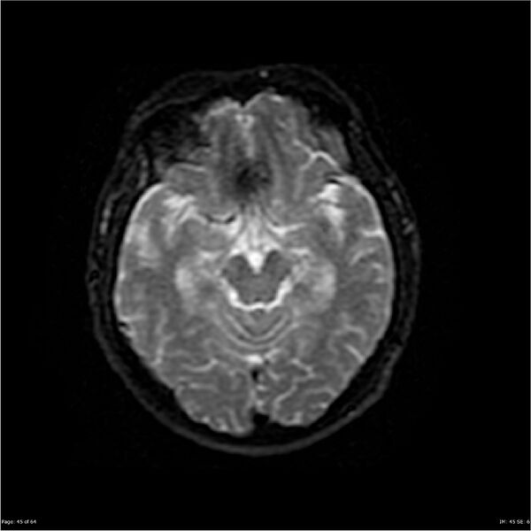File:Amnestic syndrome secondary to hypoxic brain injury (Radiopaedia 24743-25004 DWI 45).jpg