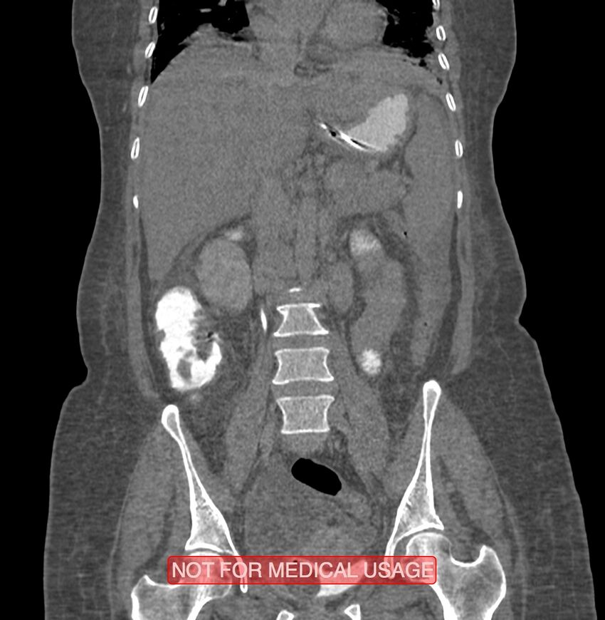 Amoebic enterocolitis with liver abscess (Radiopaedia 35100-36609 B 109).jpg
