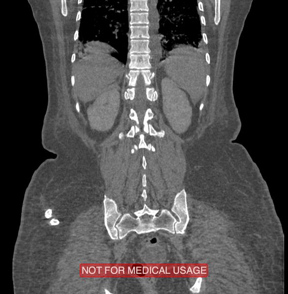 File:Amoebic enterocolitis with liver abscess (Radiopaedia 35100-36609 B 166).jpg