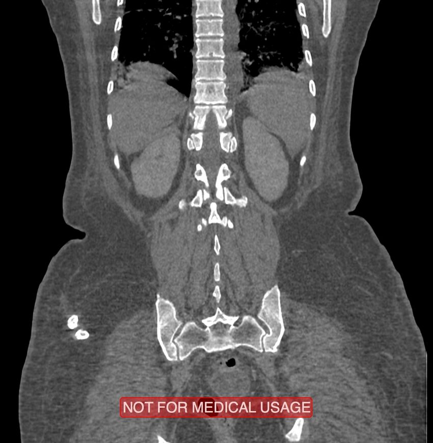 Amoebic enterocolitis with liver abscess (Radiopaedia 35100-36609 B 166).jpg