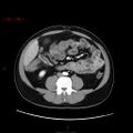 Ampullary carcinoma (Radiopaedia 56396-63056 B 44).jpg