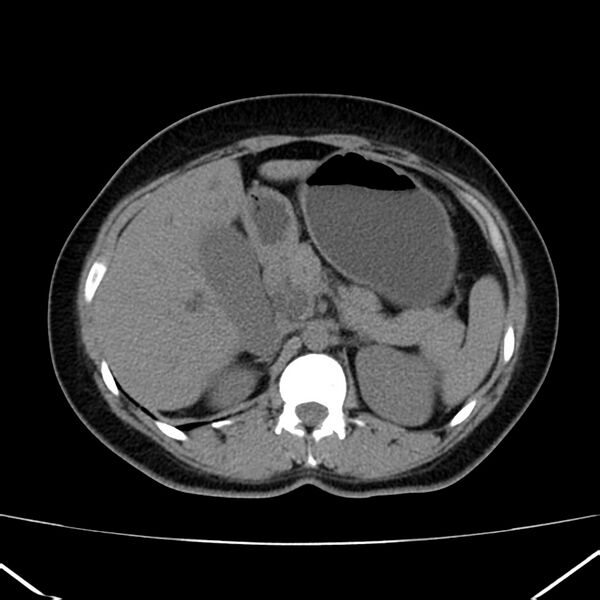 File:Ampullary tumor (Radiopaedia 22787-22816 Axial non-contrast 18).jpg