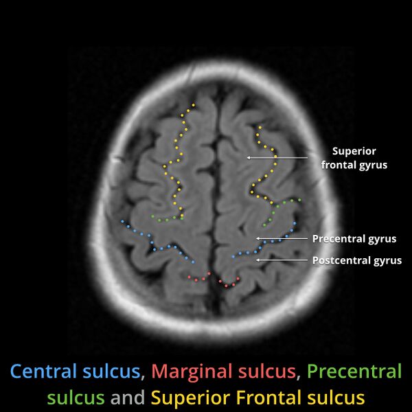 File:Anatomy- sulci of the brain (Radiopaedia 33834-34995 Central sulcus 10).jpg