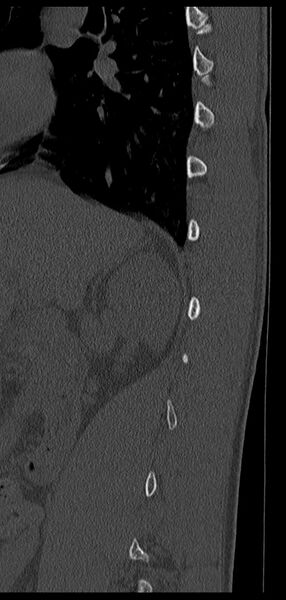 File:Aneurysmal bone cyst T11 (Radiopaedia 29294-29721 Sagittal bone window 63).jpg