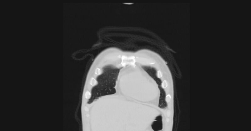 File:Angioinvasive aspergellosis (Radiopaedia 66995-76315 Coronal lung window 4).jpg