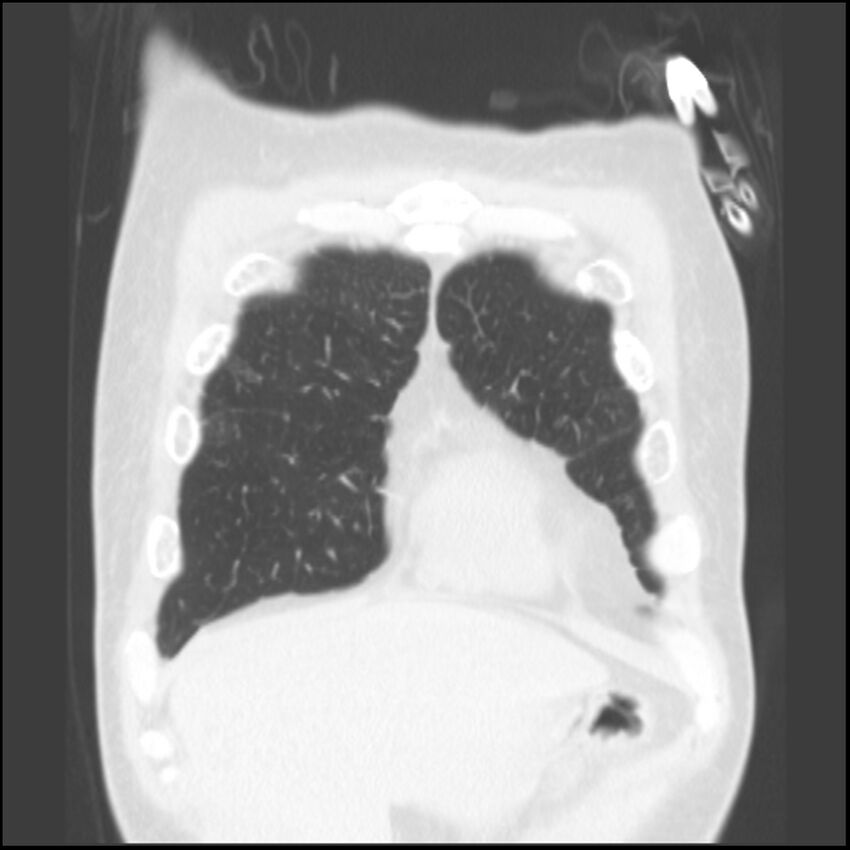 Angioinvasive aspergillosis (Radiopaedia 43957-47466 Coronal lung window 79).jpg