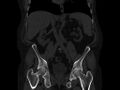 Ankylosing spondylitis (Radiopaedia 44609-48357 Coronal bone window 37).jpg