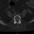 Ankylosing spondylitis (Radiopaedia 8748-9556 Axial bone window 43).jpg