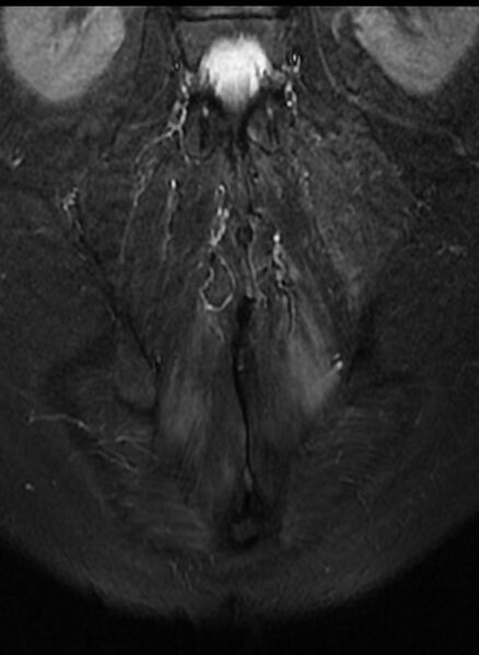 File:Ankylosing spondylitis - Andersson lesion (Radiopaedia 81878-95838 Coronal STIR 13).jpg