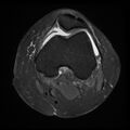 Anterior cruciate ligament tear, Wrisberg rip and bucket-handle tear of medial meniscus (Radiopaedia 75872-87266 Axial PD fat sat 18).jpg