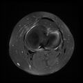 Anterior cruciate ligament tear, Wrisberg rip and bucket-handle tear of medial meniscus (Radiopaedia 75872-87266 Axial PD fat sat 9).jpg