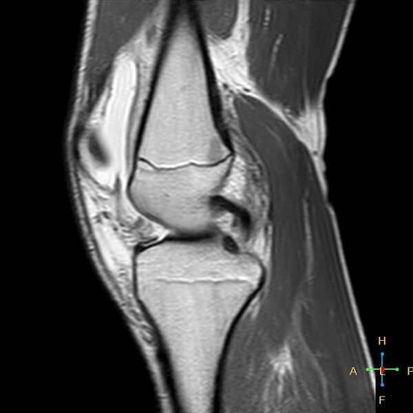 File:Anterior cruciate ligament tear - complete (Radiopaedia 24907-25170 Sagittal PD 11).jpg