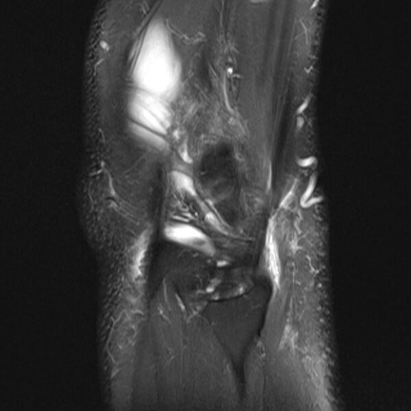 File:Anterior cruciate ligament tear - ramp lesion (Radiopaedia 71883-82322 Sagittal PD fat sat 3).jpg