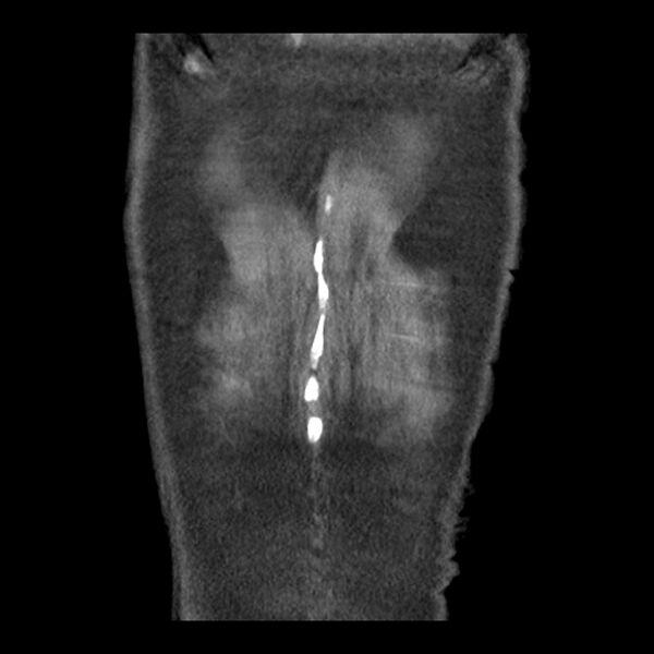 File:Aortic arch graft infection (FDG PET-CT) (Radiopaedia 71975-82437 Coronal 58).jpg
