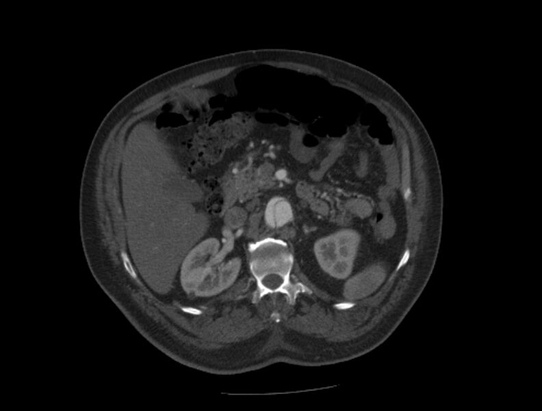 File:Aortic dissection (Radiopaedia 28802-29105 A 52).jpg