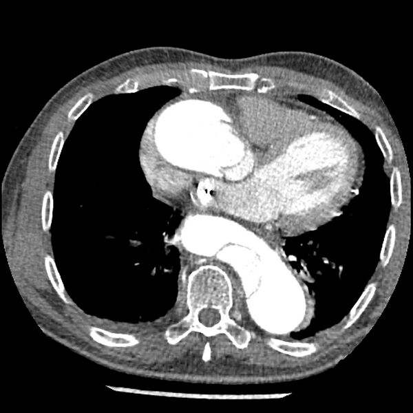 File:Aortic dissection - DeBakey Type I-Stanford A (Radiopaedia 79863-93115 A 24).jpg