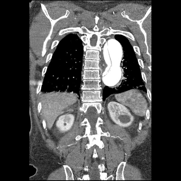 File:Aortic dissection - DeBakey Type I-Stanford A (Radiopaedia 79863-93115 B 31).jpg
