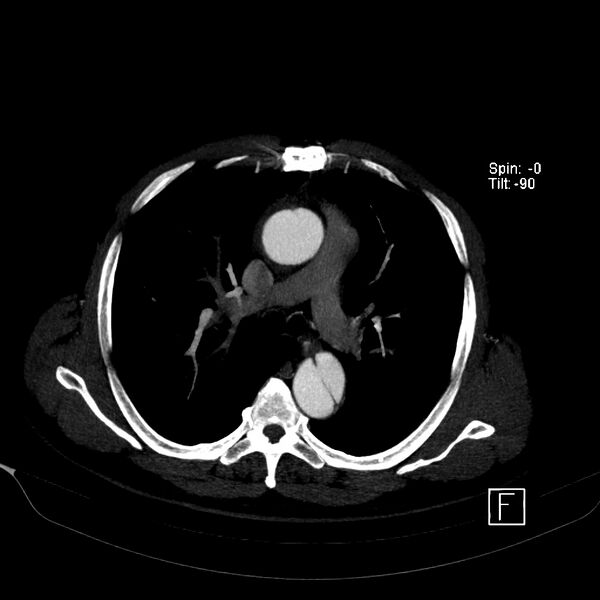 File:Aortic dissection - De Bakey type III - Stanford B (Radiopaedia 21903-21882 B 24).jpg