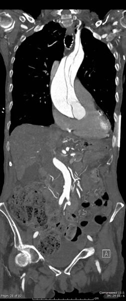 File:Aortic dissection with extension into aortic arch branches (Radiopaedia 64402-73204 A 28).jpg