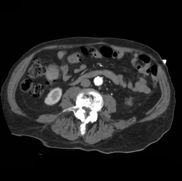 File:Aortic dissection with rupture into pericardium (Radiopaedia 12384-12647 A 67).jpg