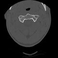 Apical pneumothorax on cervical spine CT (Radiopaedia 45343-49368 Axial bone window 22).jpg