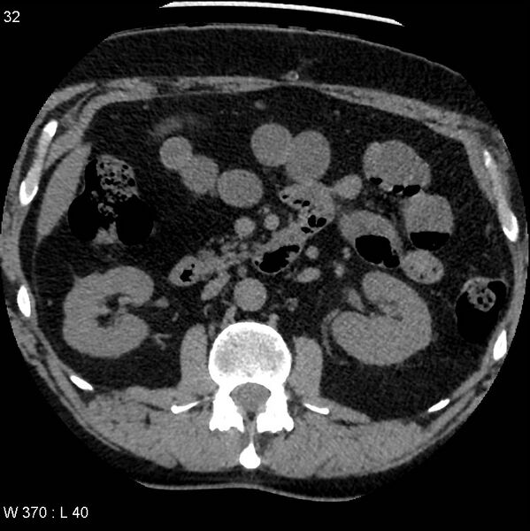File:Appendicitis (Radiopaedia 12510-12733 Axial non-contrast 3).jpg